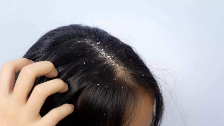 मानसून में सिर में खुजली और डैंड्रफ से हैं परेशान? ये 1 हेयर मास्क बना देगा फर्क!